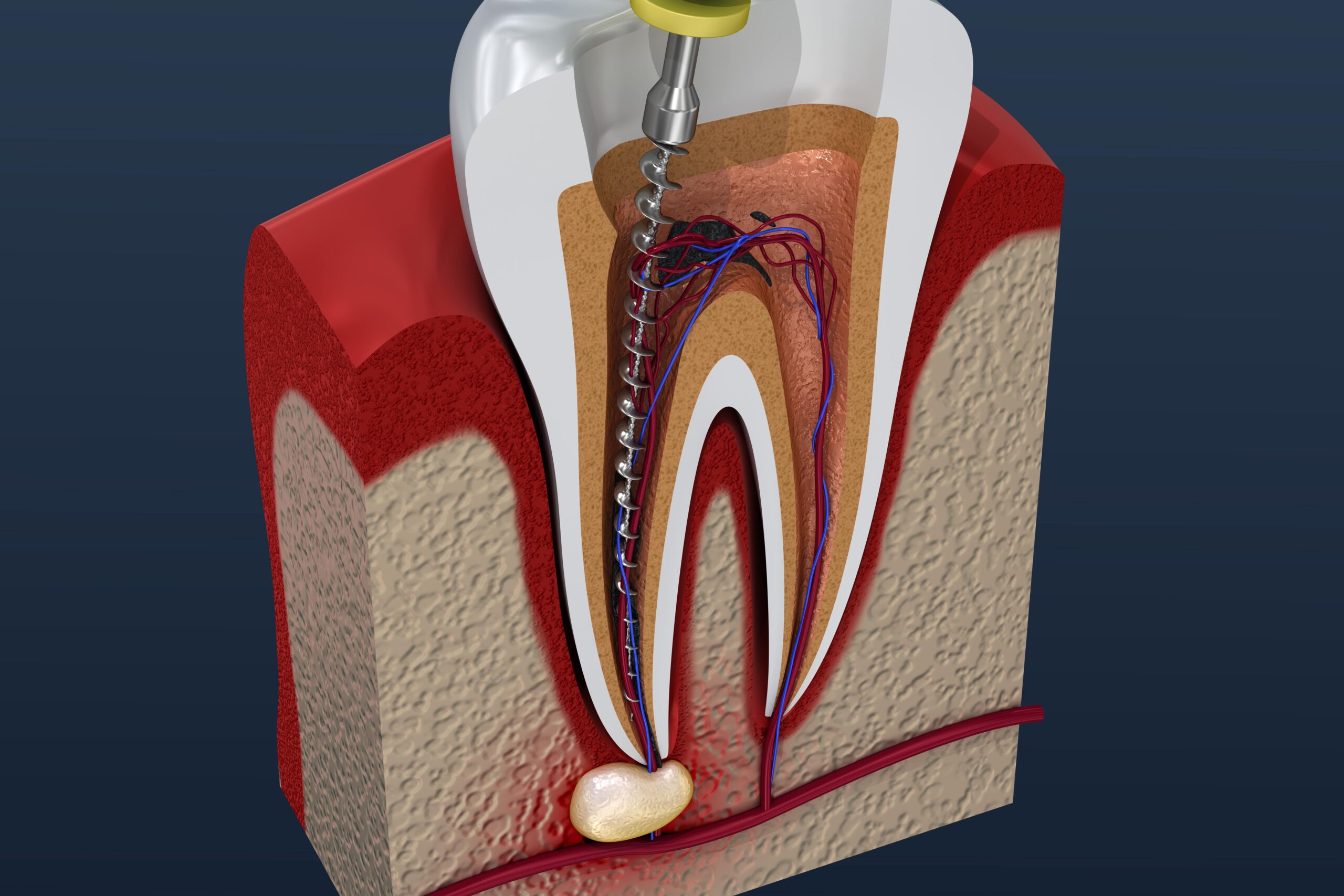 Root canal therapy educational illustration