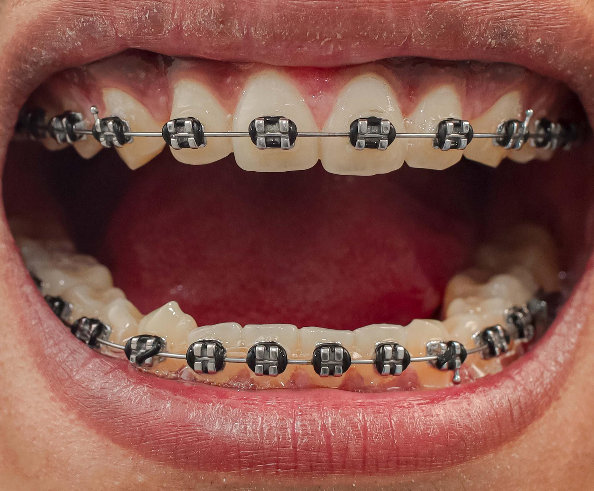 Complete Guide to Braces: Types, Process & Results