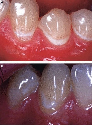 Caries Activity vs Arrest — Decision Tree Protocol