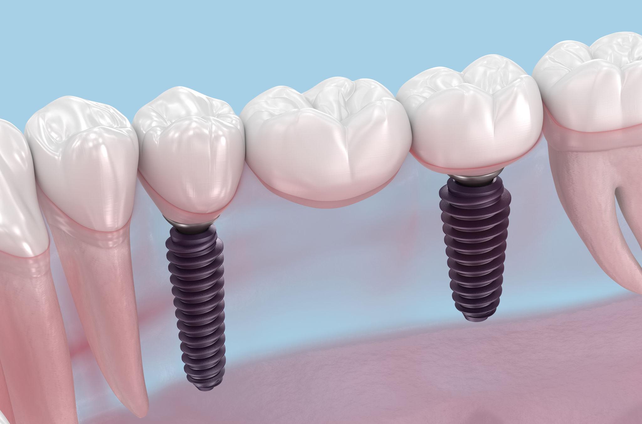 Dental Implants: Complete Guide for Patients