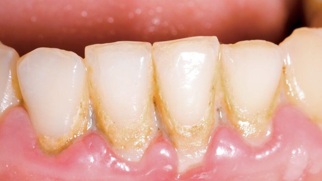 Gum Disease: Causes, Symptoms, Stages & Treatment (Complete Guide 2026)