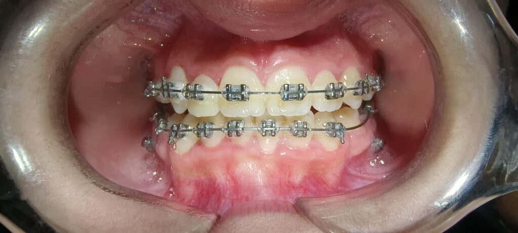 Complete Guide to Braces: Types, Treatment Process, Timeline and Results