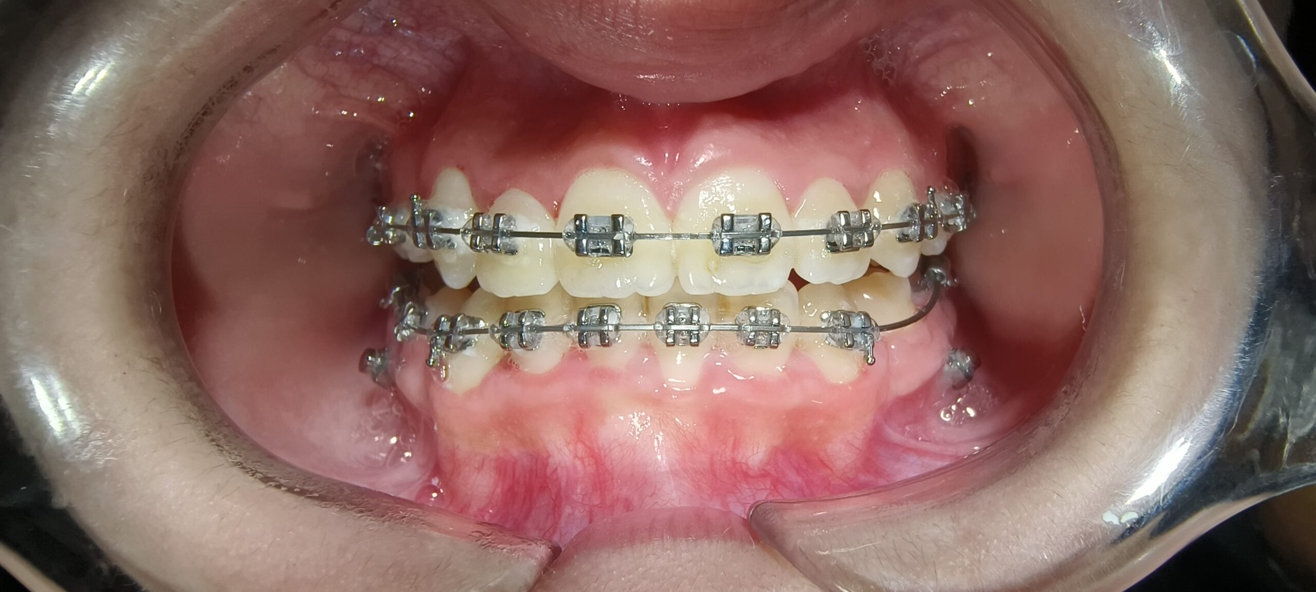 Complete Guide to Braces: Types, Treatment Process, Timeline and Results